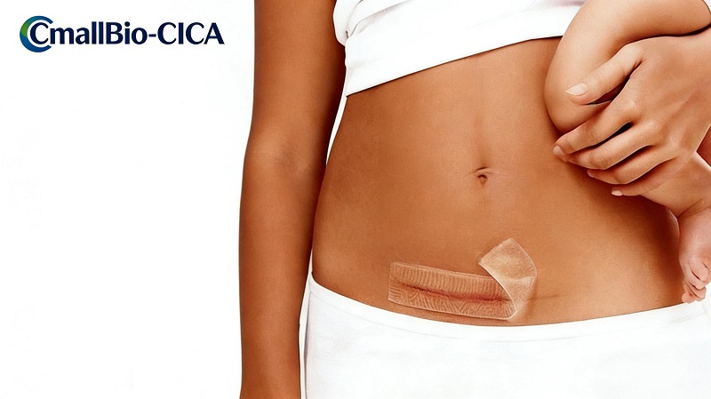 CmallBio Thickened Silicone Scar Patch (CmallBio-CICA) presterar briljant nyligen och stabiliserar sin position i toppskiktet av medicinskt silikonärrborttagningsområde