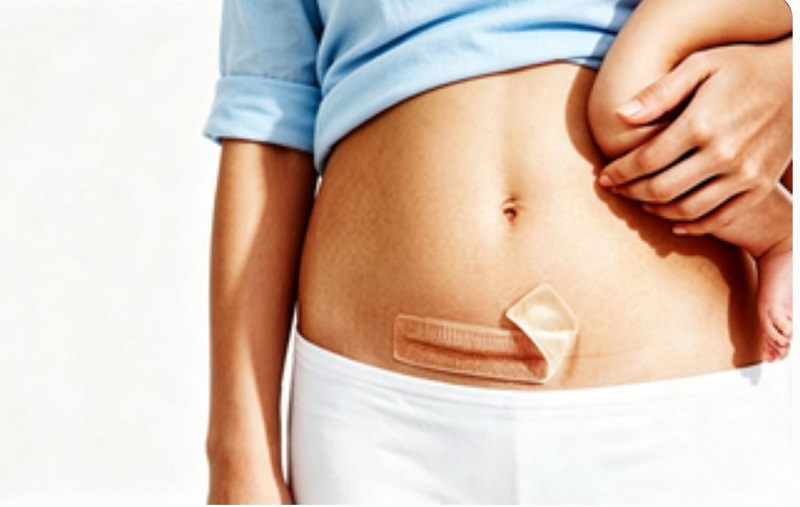 Säker hormonfri CmallBio Silikon ärrplåster för kejsarsnitt ärrvård
